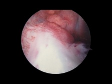 Anterior cruciate ligament seen under arthroscopy