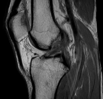 Knee MRI scan